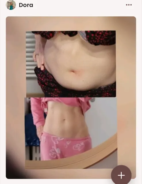 Foto prima e dopo post-gravidanza di Dora, che ha perso 10kg con il Pilates Linfodrenante
