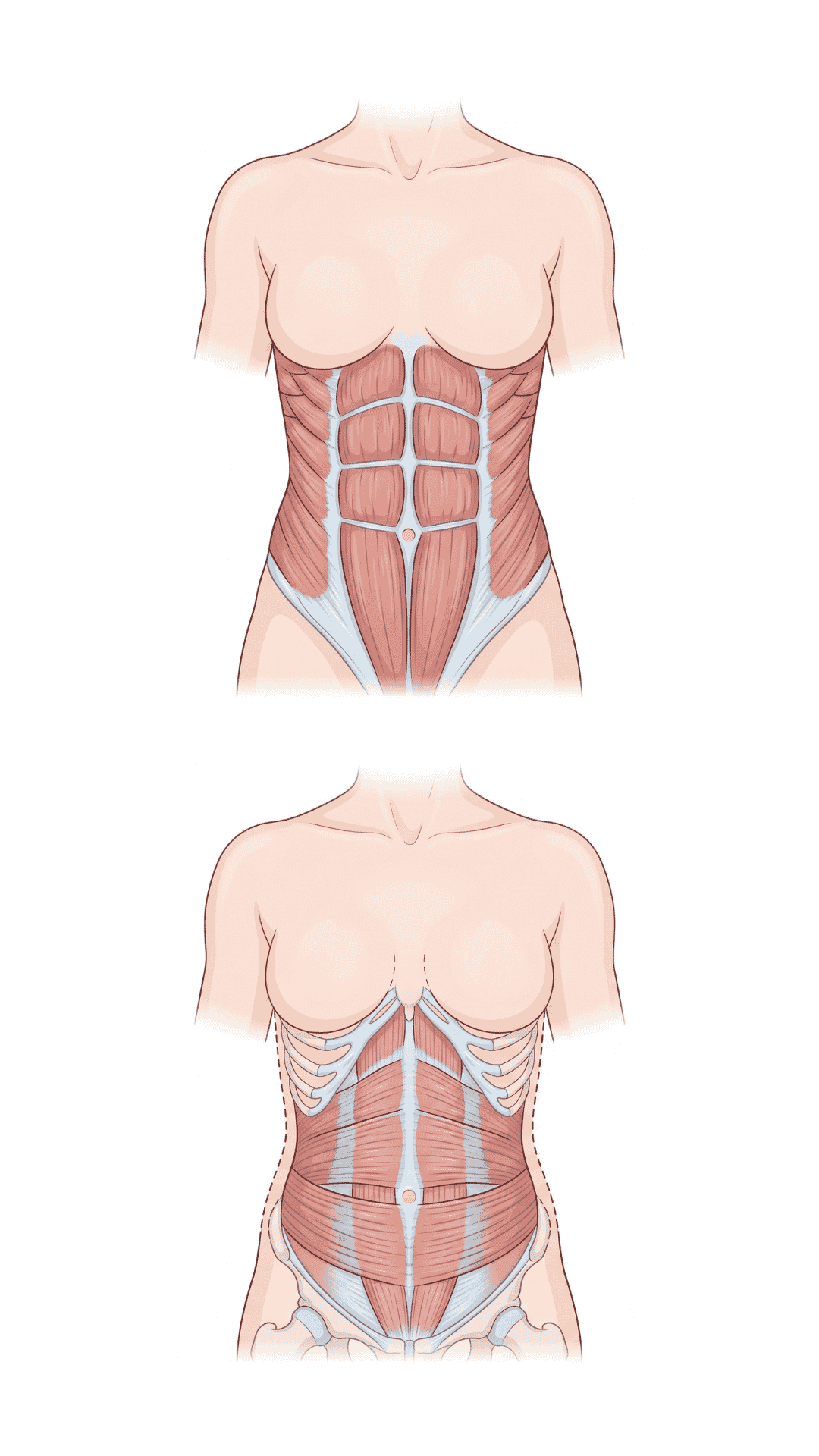 Anatomical illustration of the superficial abdominals and deep transversus abdominis — the deep muscle acts as a natural corset to reduce abdominal swelling