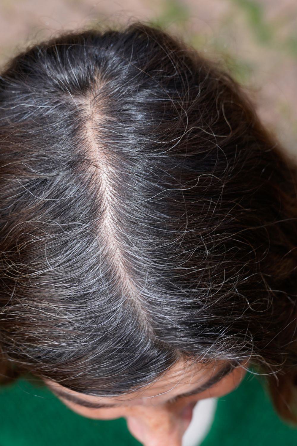 Cuoio capelluto con diradamento visibile nella scriminatura centrale — sintomo del pattern femminile di caduta dei capelli spesso collegato a carenza di vitamina D e ferro