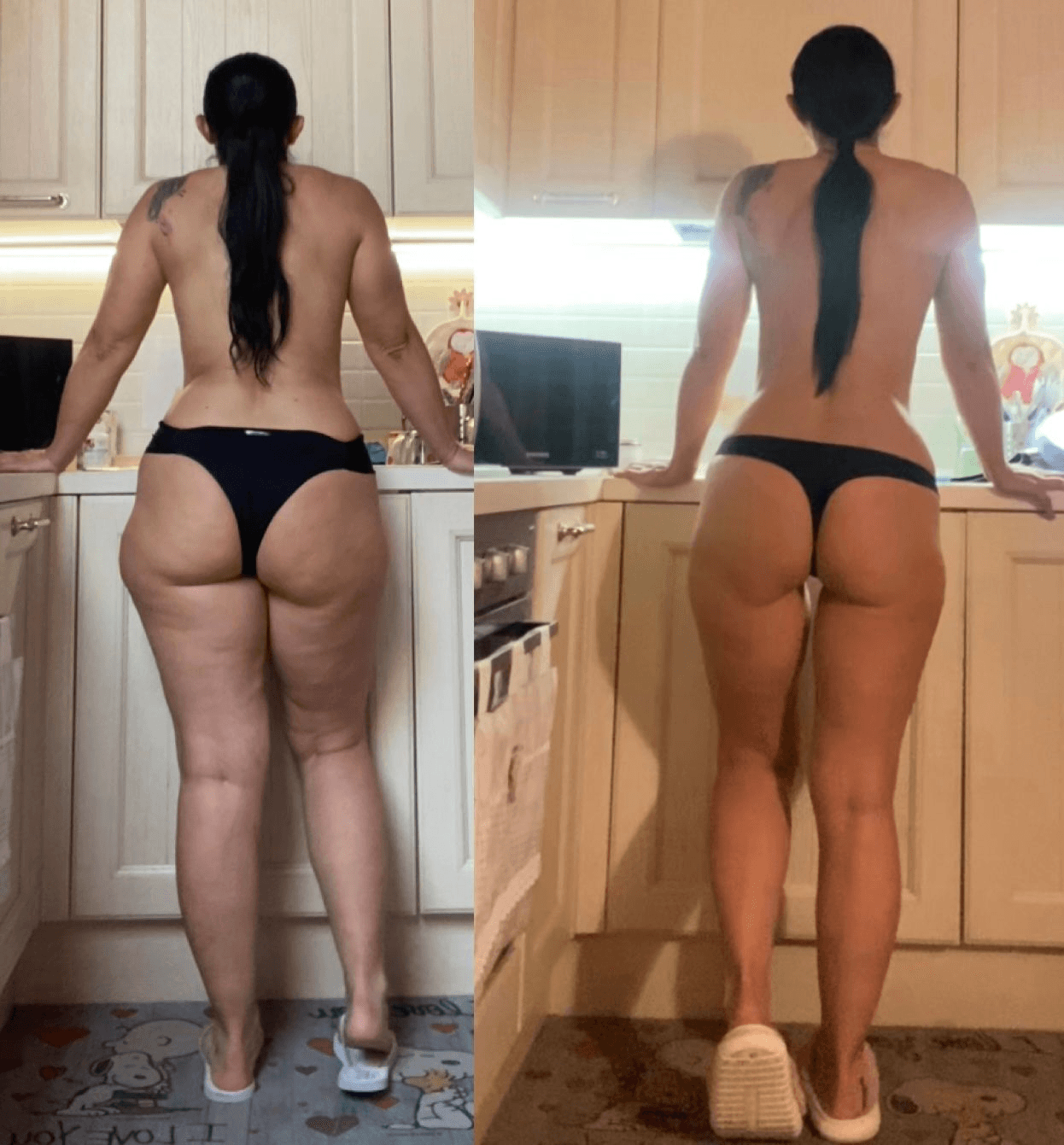 Prima e dopo Pilates Linfodrenante per lipedema: riduzione visibile del tessuto adiposo su fianchi e cosce con gambe più proporzionate