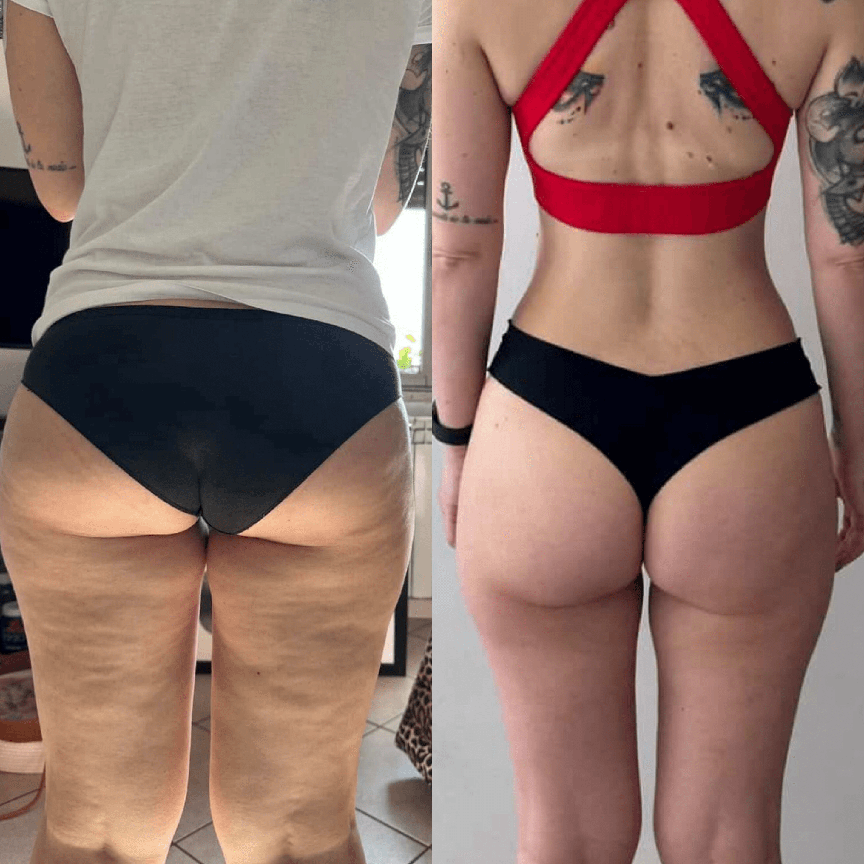 Prima e dopo Pilates Linfodrenante per lipedema: riduzione visibile del tessuto adiposo su cosce e glutei con pelle più tonica