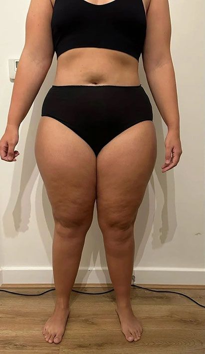 Donna con gambe e cosce gonfie sproporzionate rispetto alla parte superiore del corpo, possibile segnale visivo di lipedema da valutare con diagnosi specialistica