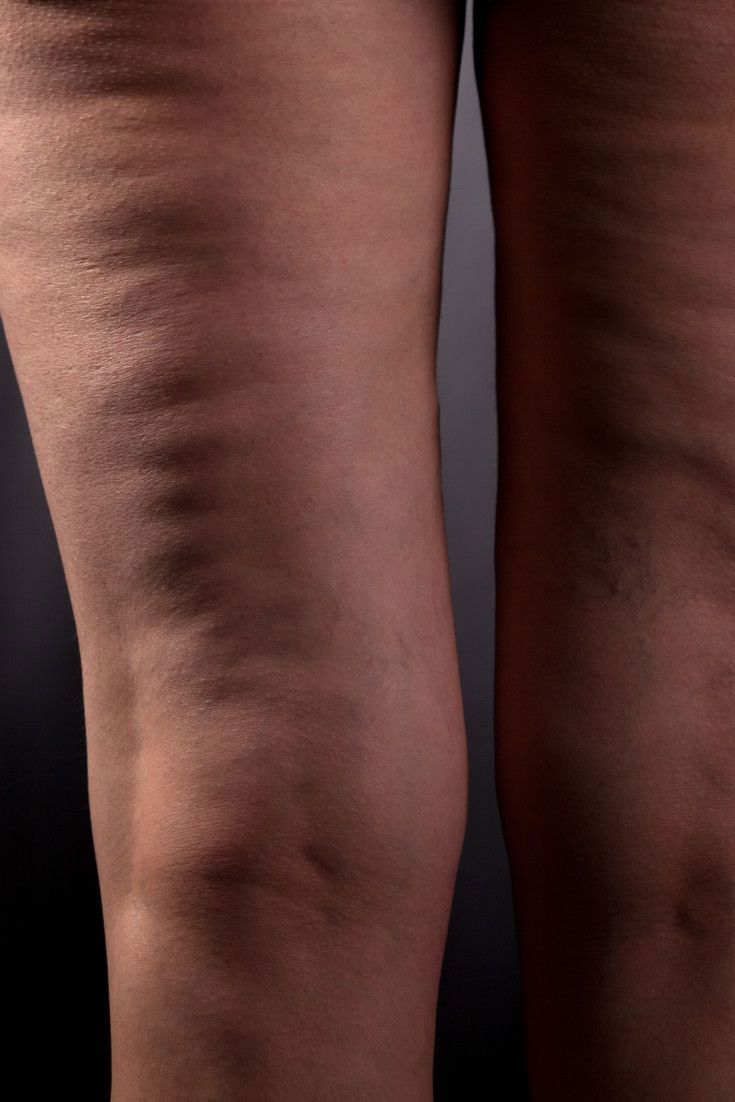 Cellulite visibile sulle cosce come segno di infiammazione cronica e ristagno linfatico, conseguenza di abitudini alimentari infiammatorie e scarsa circolazione