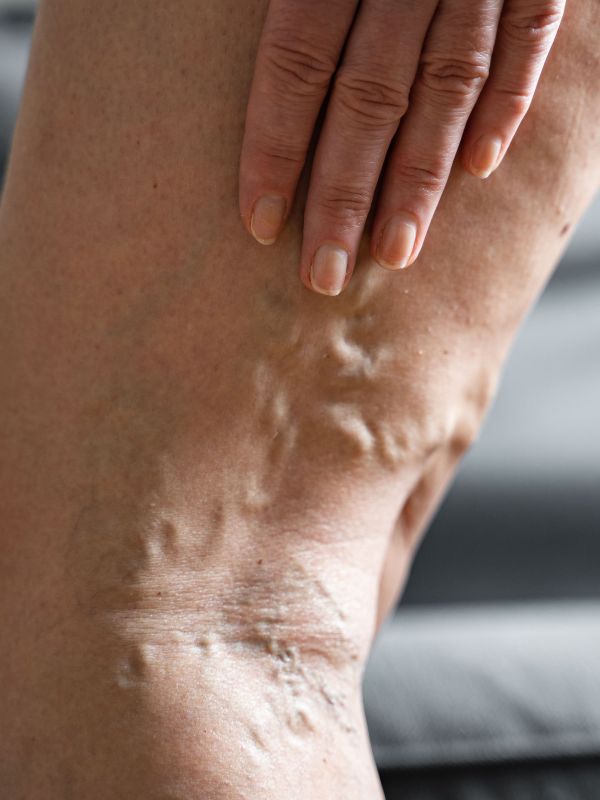 Gamba di donna con evidenti vene varicose dietro il ginocchio