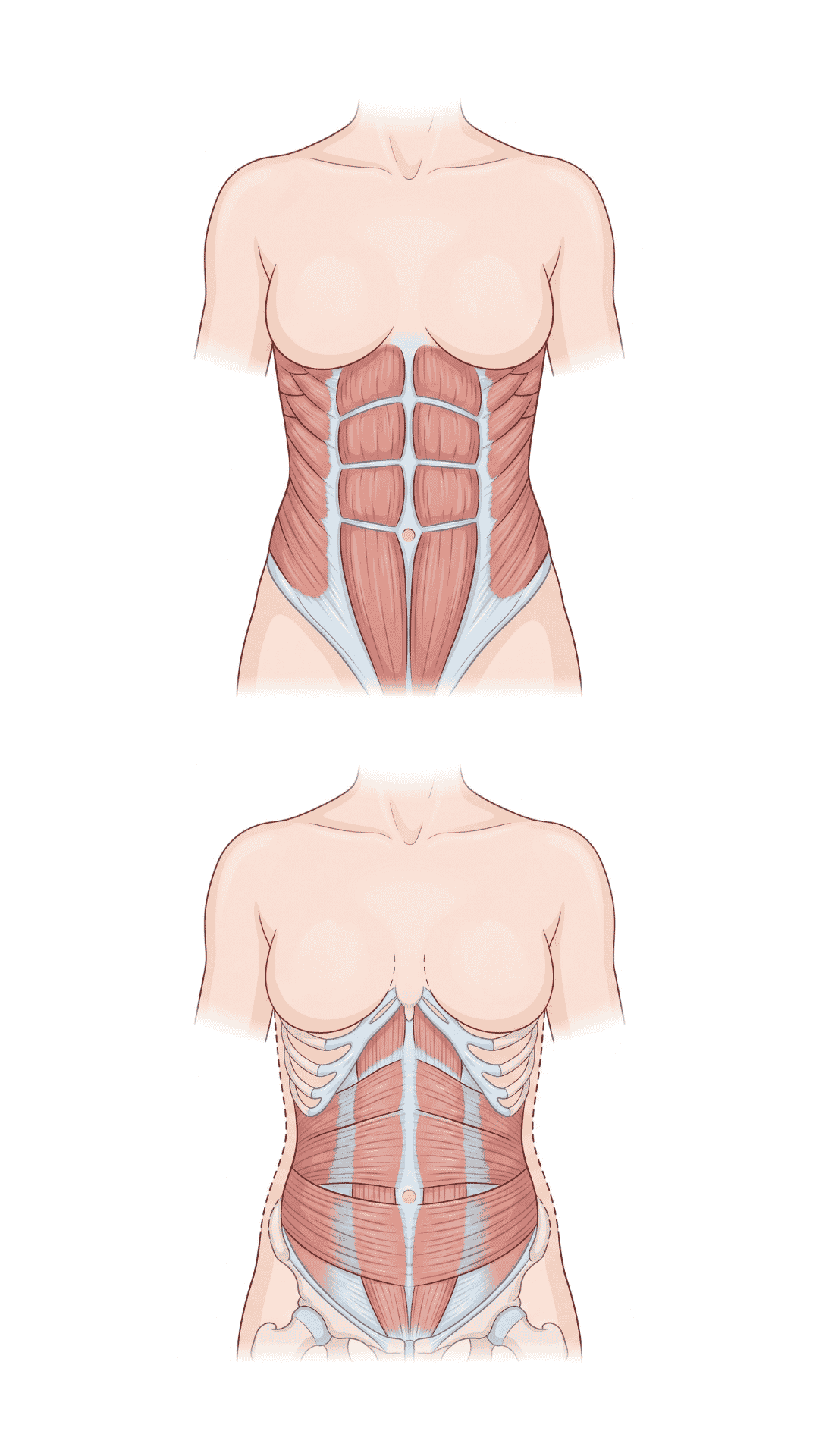 Illustrazione anatomica degli addominali superficiali e del trasverso profondo — il muscolo profondo funziona da corsetto naturale per ridurre il gonfiore addominale
