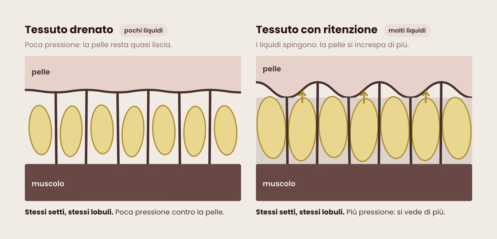 Lo stesso tessuto con pochi e con molti liquidi: setti e lobuli sono identici, ma con la ritenzione la pressione contro la pelle aumenta e la cellulite si vede di più.