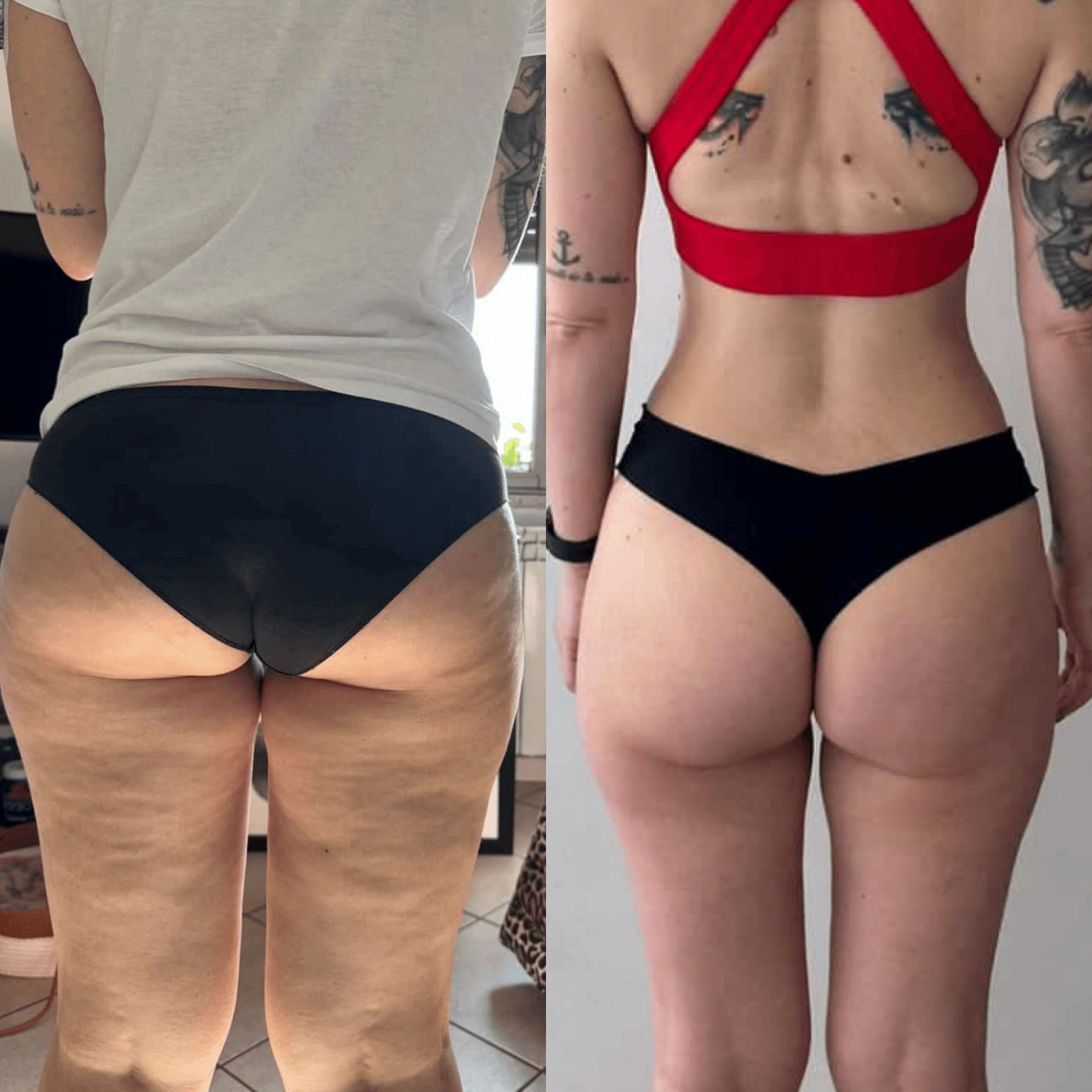 Cosce femminili (lipedema): prima e dopo il pilates linfodrenante