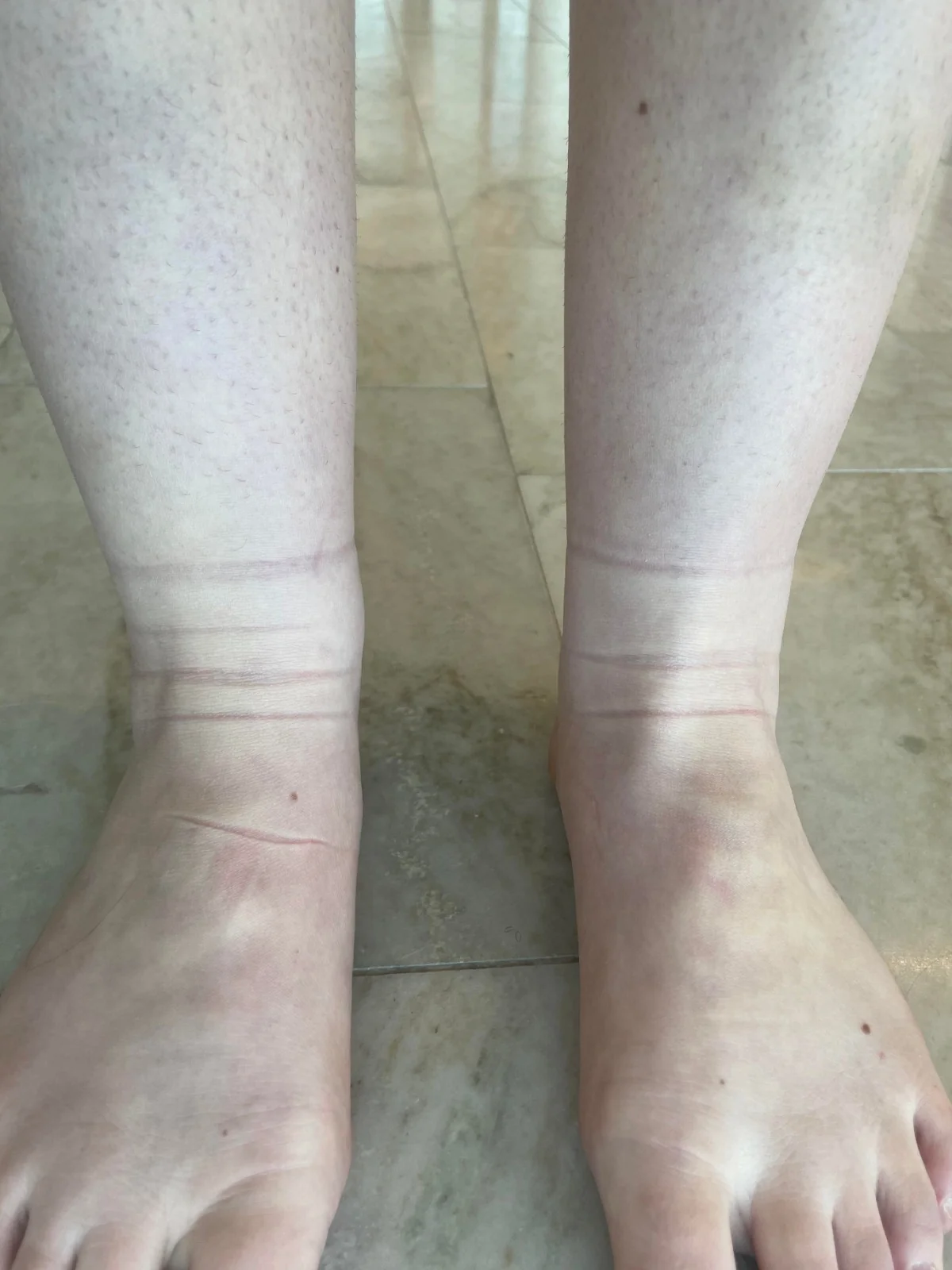 Caviglie con il segno dell'elastico dei calzini a fine giornata, tipico della ritenzione idrica alle gambe